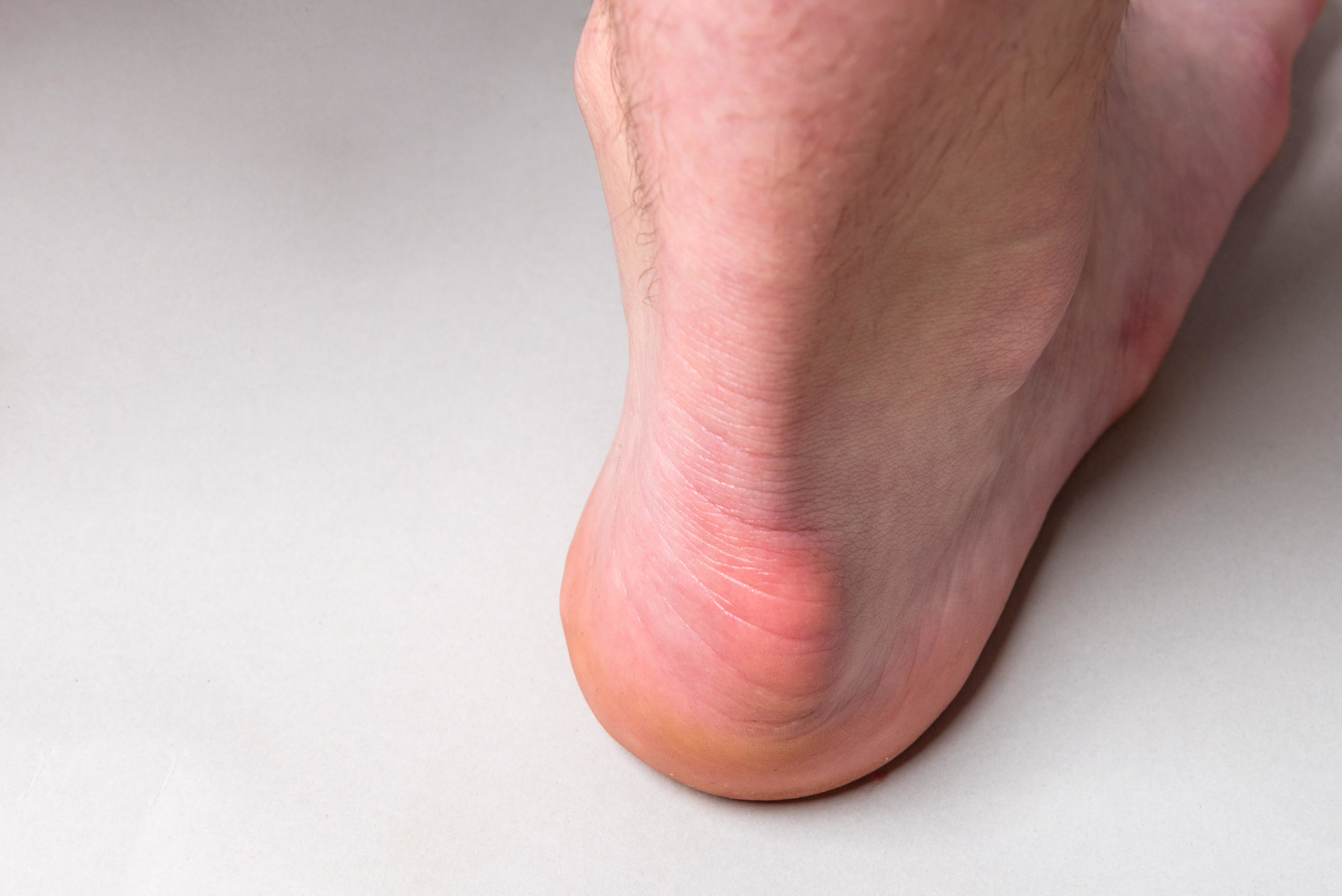 Bump on the back of heel bone called Haglund’s deformity on gray