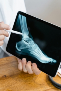 Foot bone anatomy diagram showing common fracture locations — Frisco podiatrist